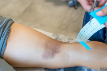 ¿Qué es un desgarro y cómo lo tratamos en CRL?