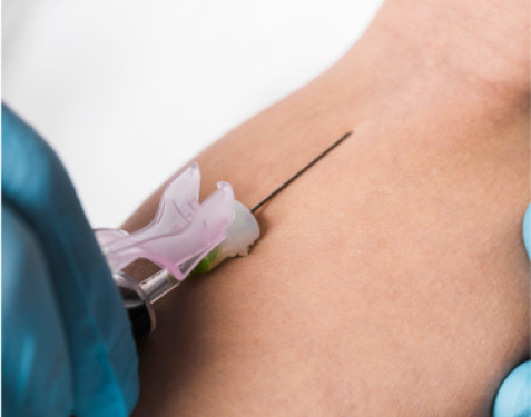 Plasma rico en plaquetas (PRP)