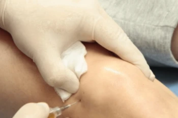 ¿Qué es la Viscosuplementación Articular y cuáles son sus beneficios para recuperar lesiones?